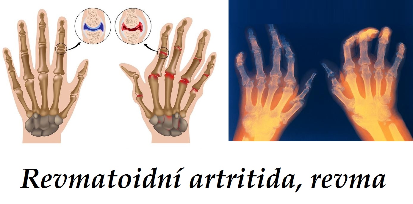 Revma, revmatismus, revmatoidní artritida - byliny, bylinky, babské rady, čaj, obklad, tinktura, mast, koupel